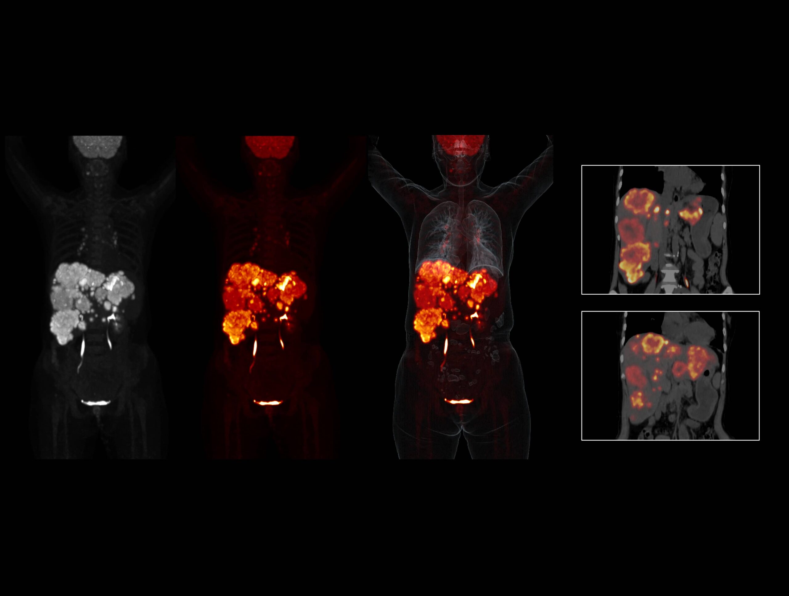 OncoFocus evidențiază clar leziunile hepatice și gastrice