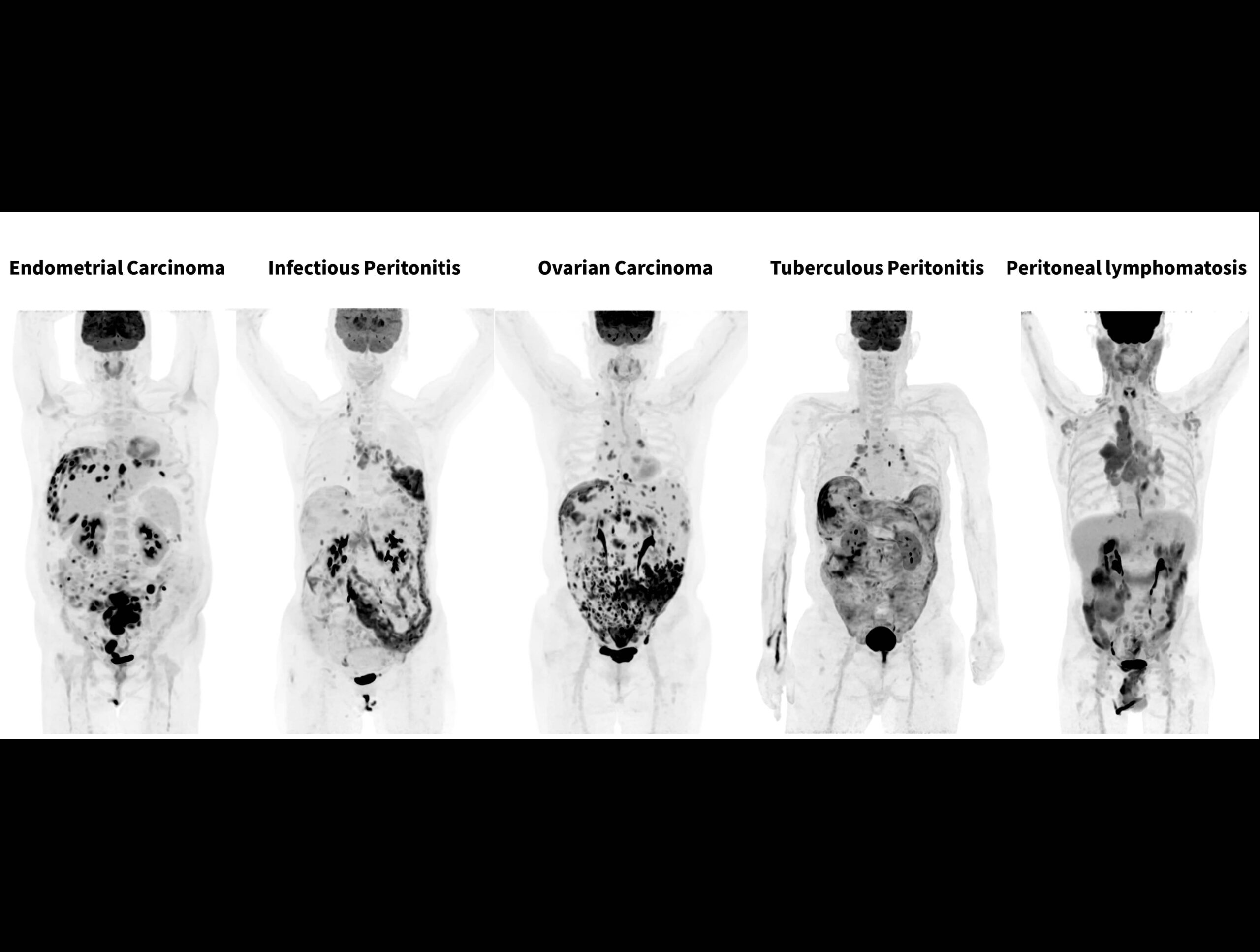 Sistemul high-resolution cu performanță TOF de 189 ps oferă imagini excepționale pentru afecțiuni peritoneale și omentale