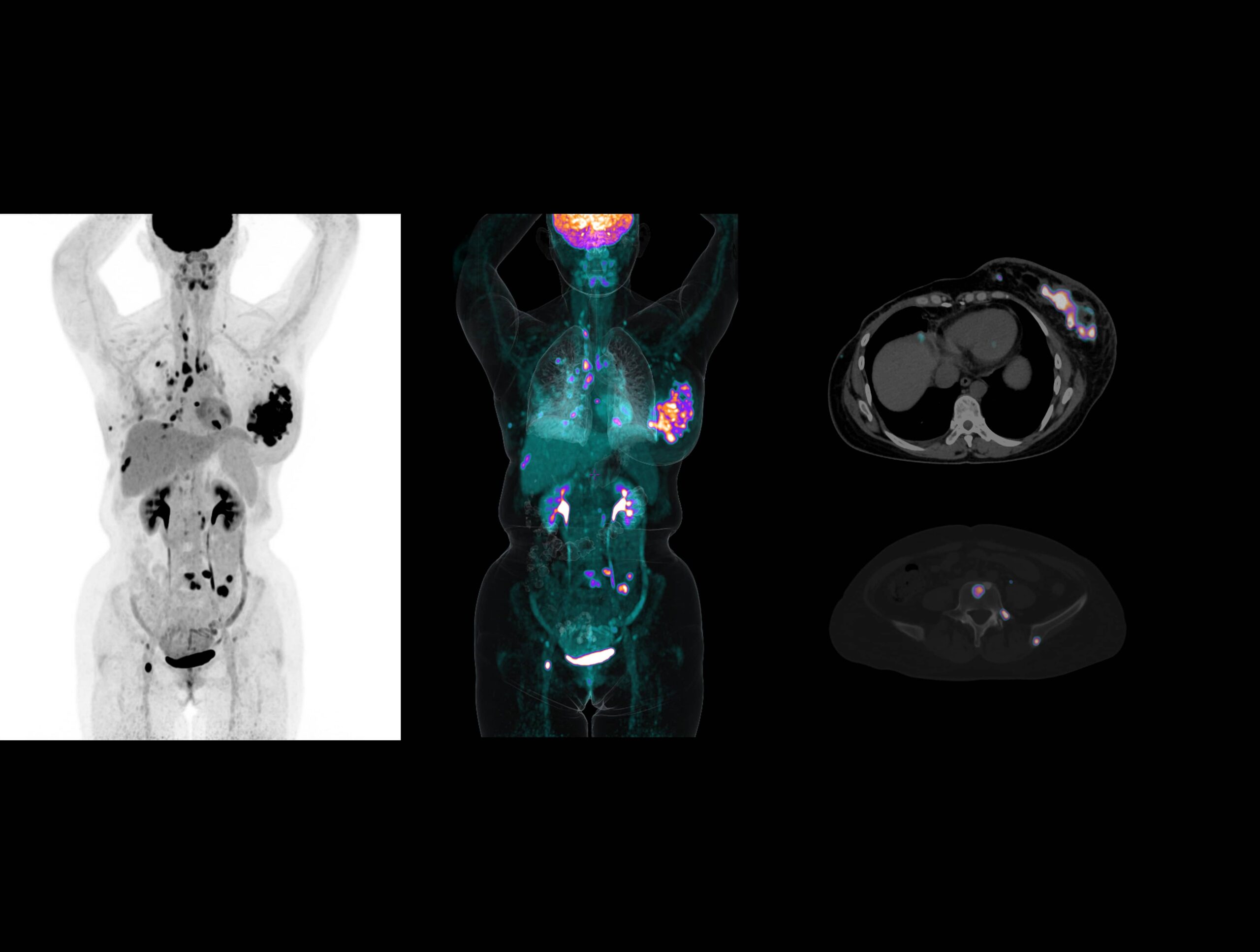 Metastazele extinse ale cancerului de sân sunt dezvăluite clar de sistemul high-resolution cu TOF ultra-rapid