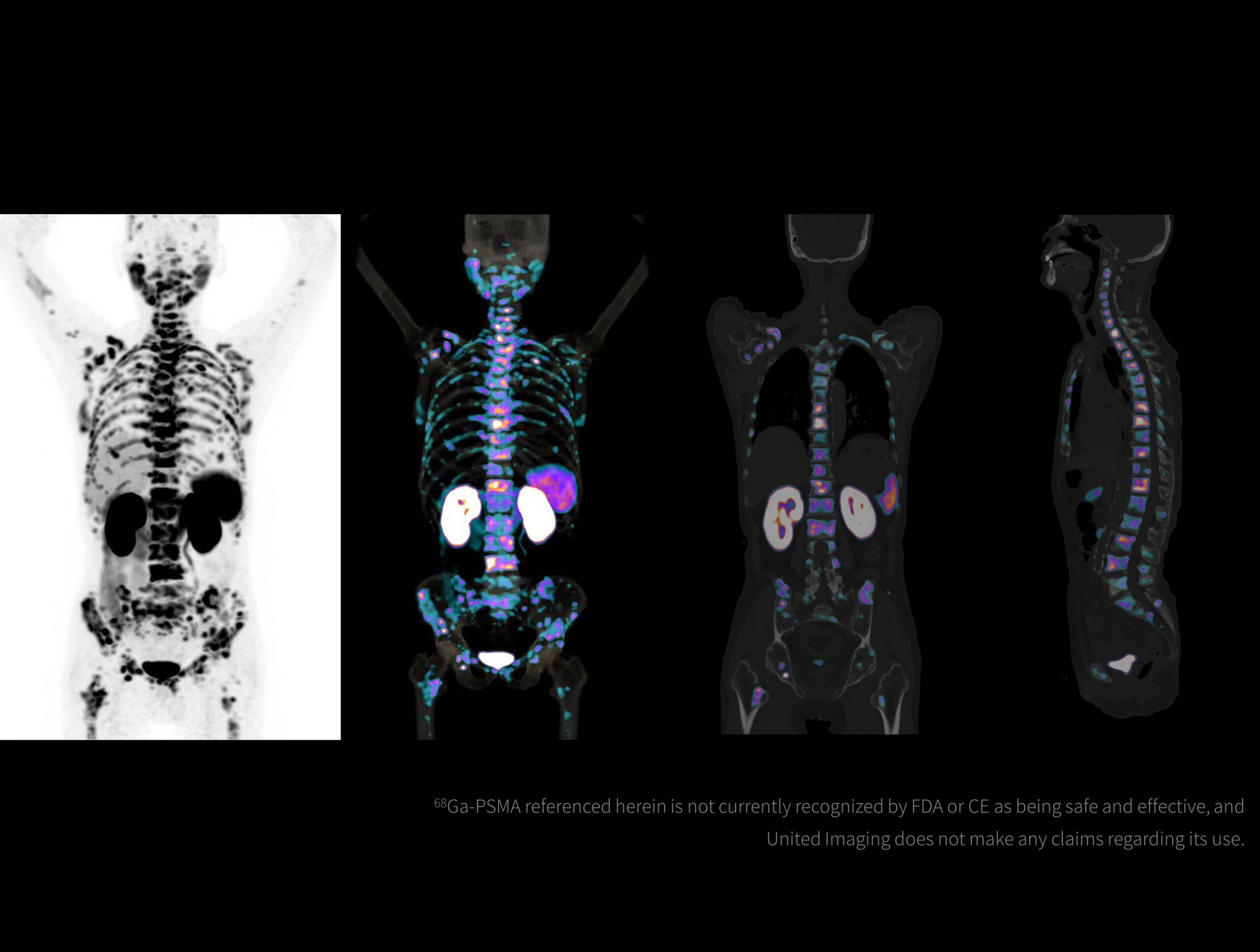 Imagistică de înaltă rezoluție obținută cu radiotrasor marcat cu galiu la doză redusă