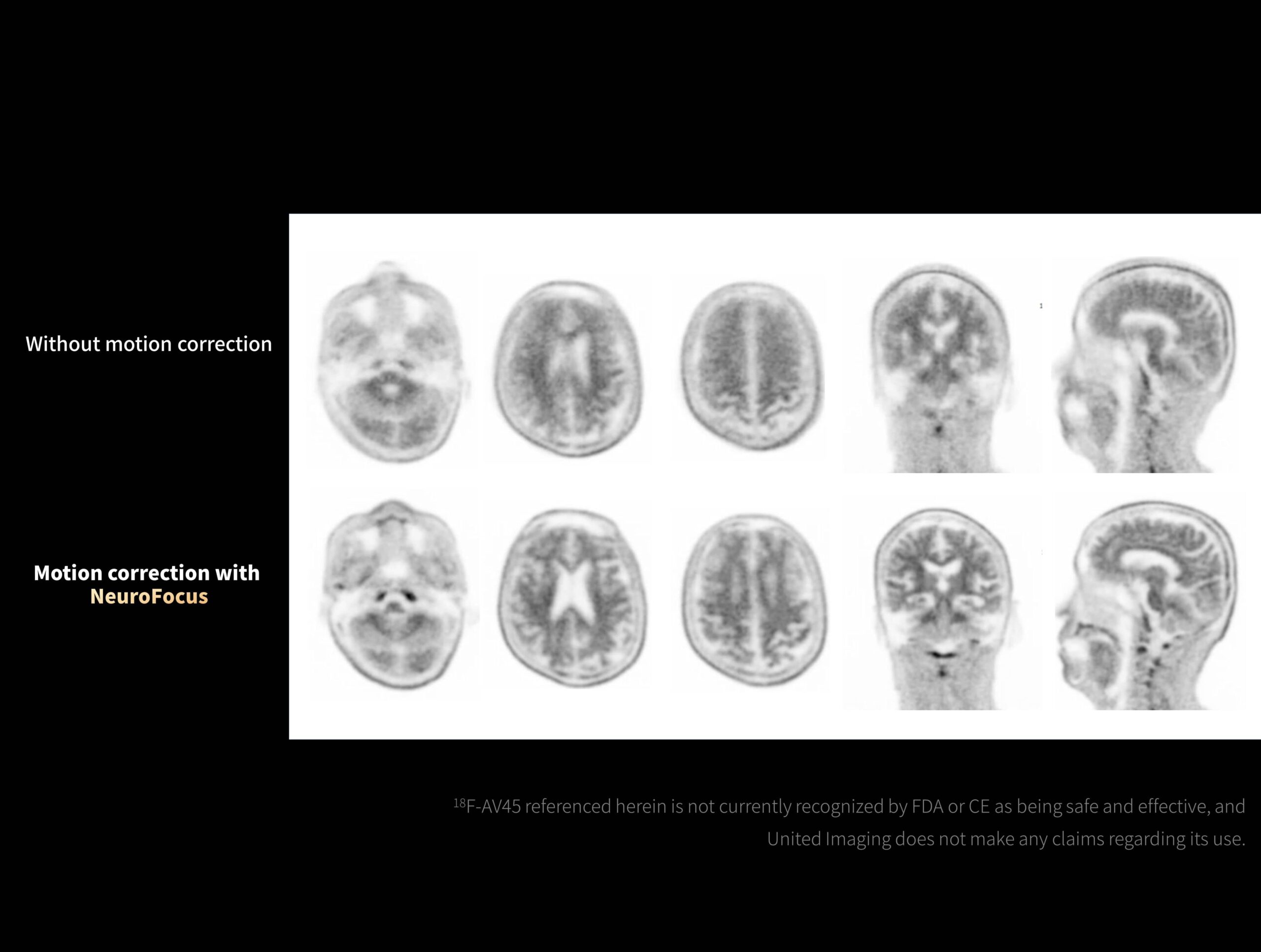 NeuroFocus reduce artefactele de mișcare în imagistica 18-F-AV45