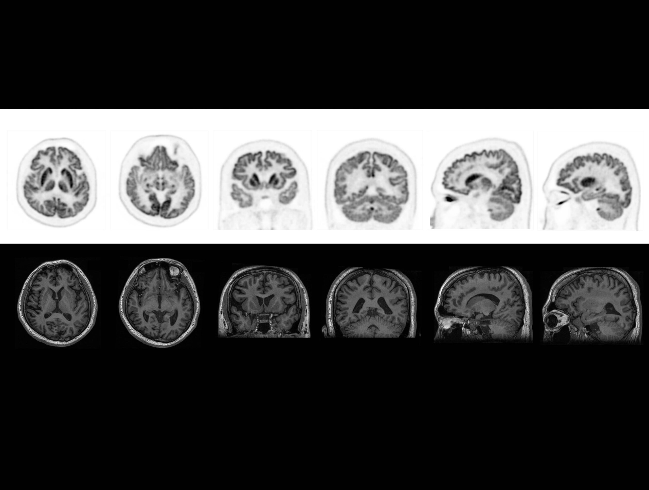 Tehnologia TOF oferă imagini high-definition ale substanței cenușii și albe la pacienții cu epilepsie, alături de RMN