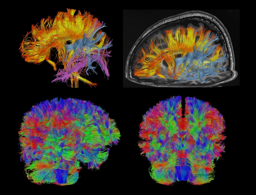 DTI cu 256 direcții pentru cap