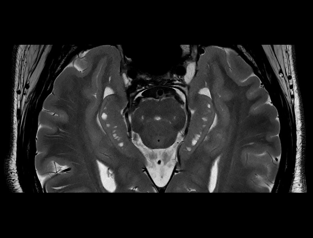 T2W FSE de înaltă rezoluție pentru hipocamp