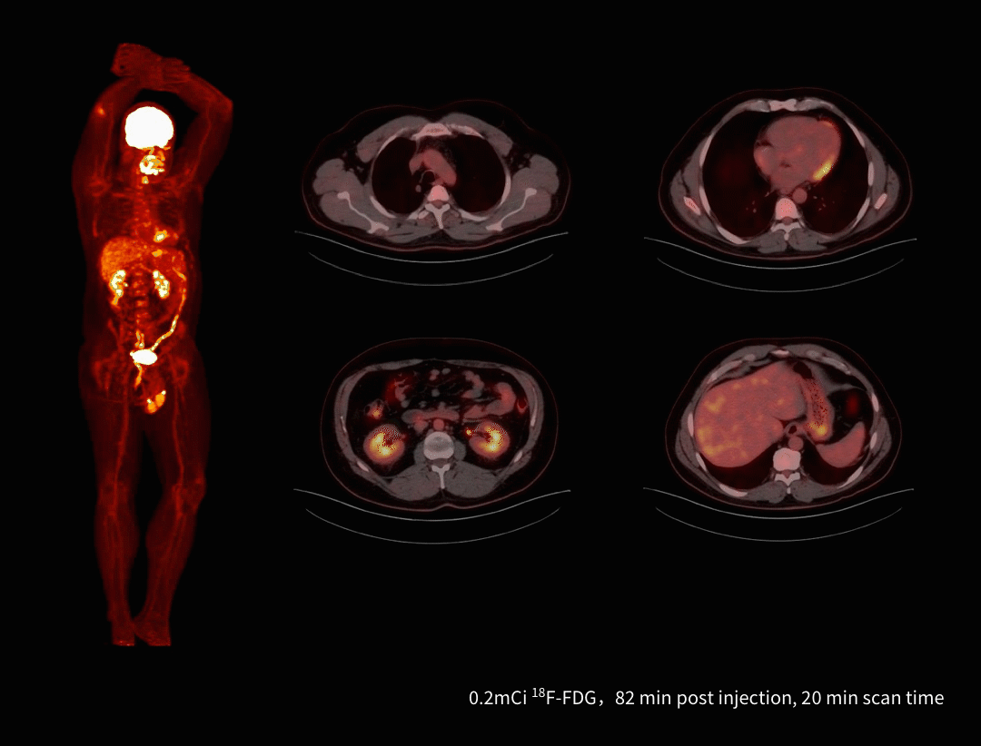 Imagistică PET/CT cu doză redusă de radiotrasor