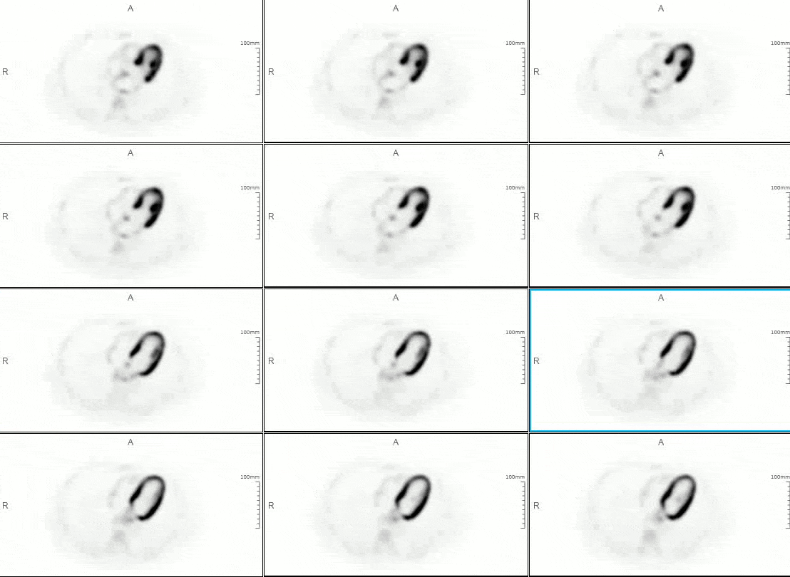 Imagistică pentru viabilitatea cardiacă