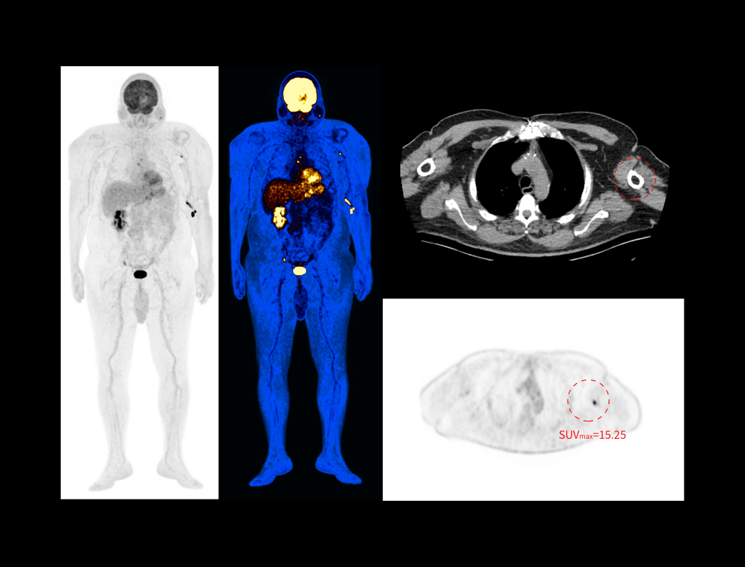 Imagistică PET/CT pentru pacienți cu indice BMI de 40,3