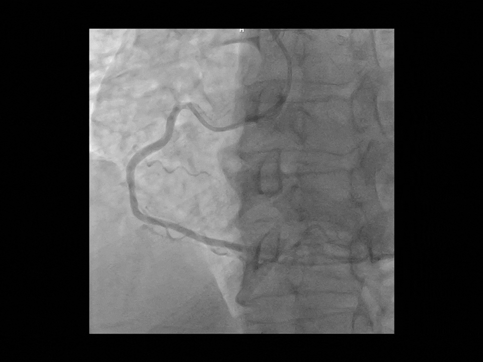 Îmbunătățire coronariană asistată de AI*