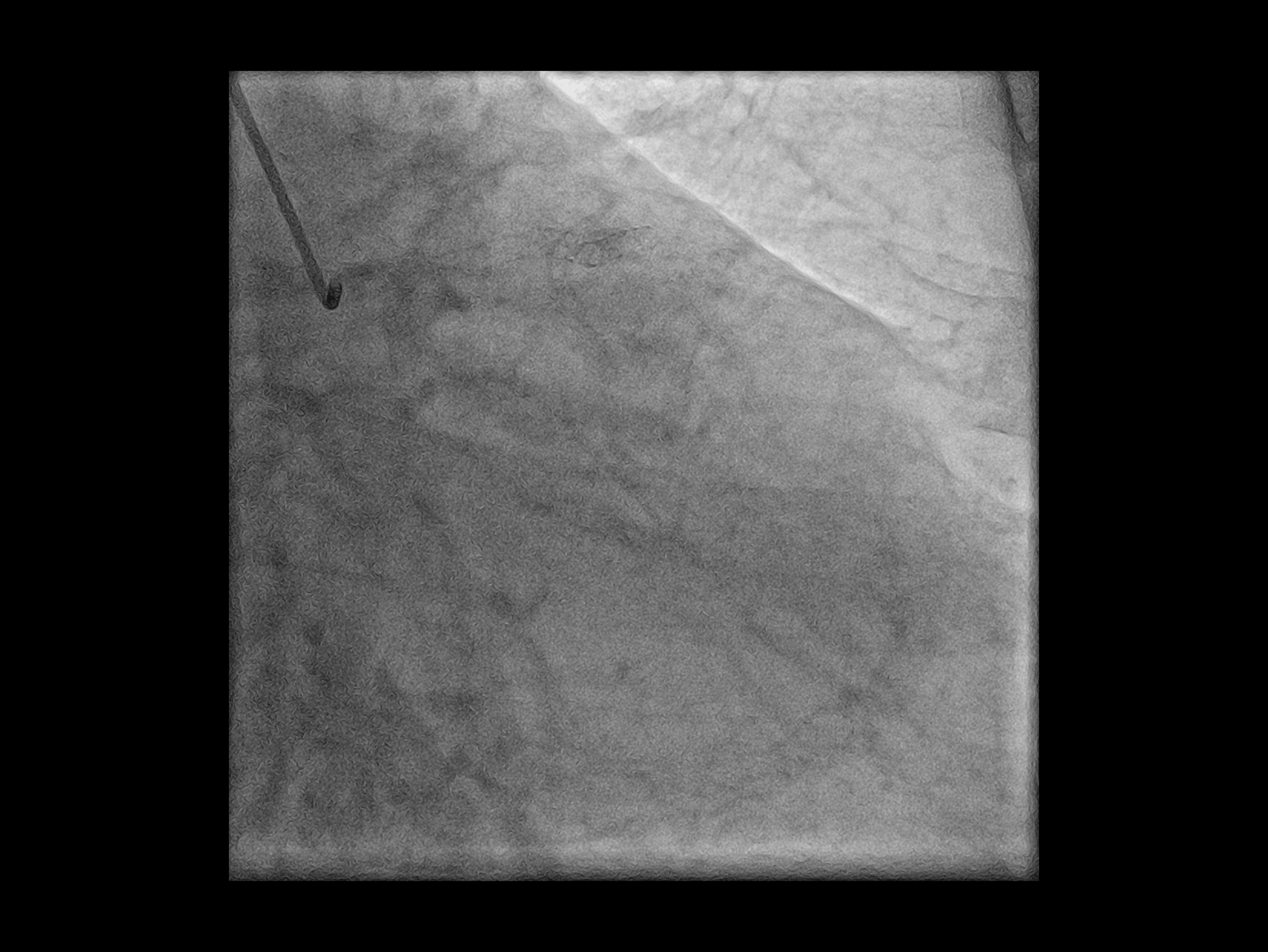 Hartă coronariană dinamică*