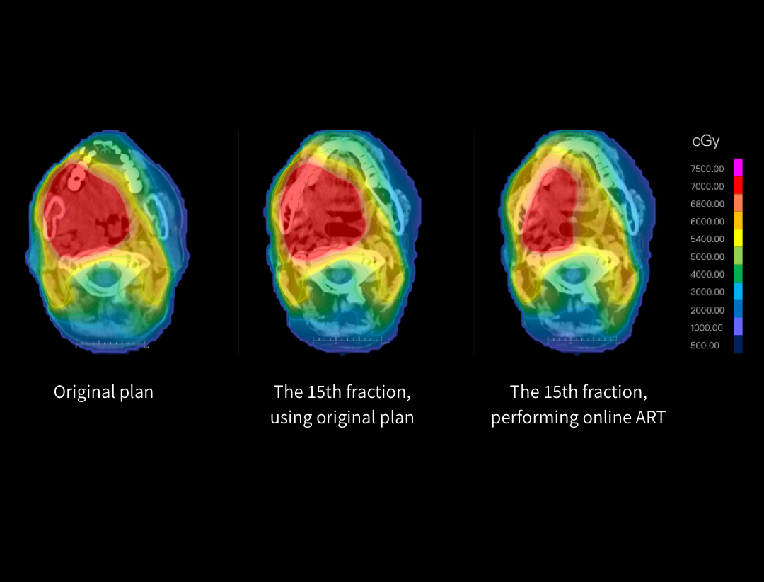 Aplicarea radioterapiei adaptive online (ART) în cancerul orofaringian