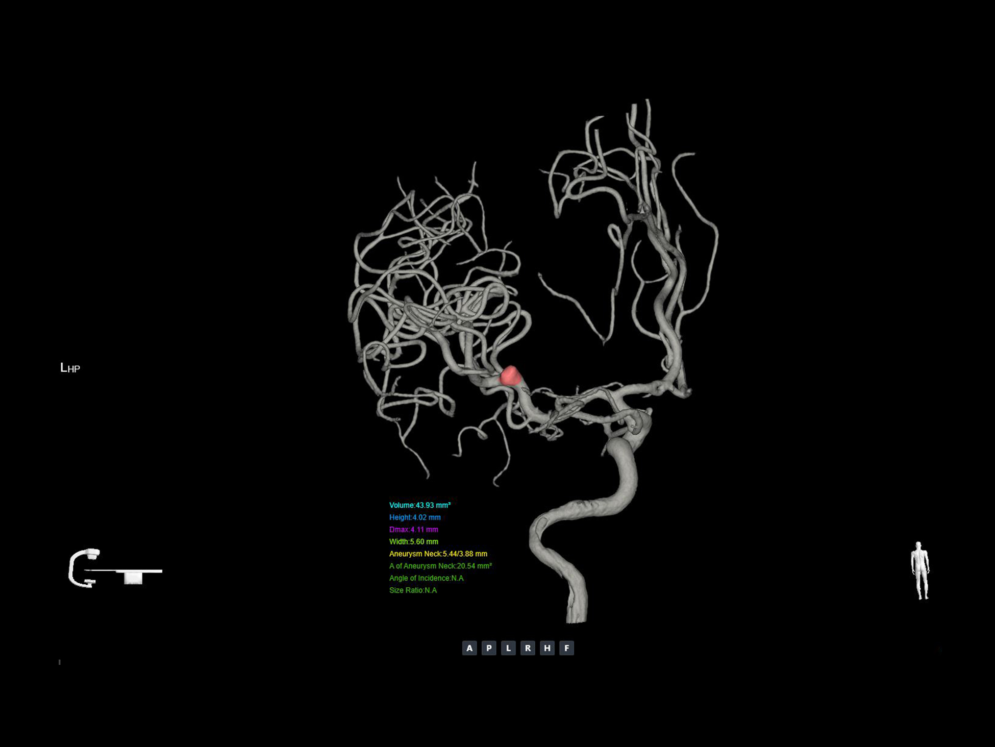 Analiză 3D a anevrismelor*