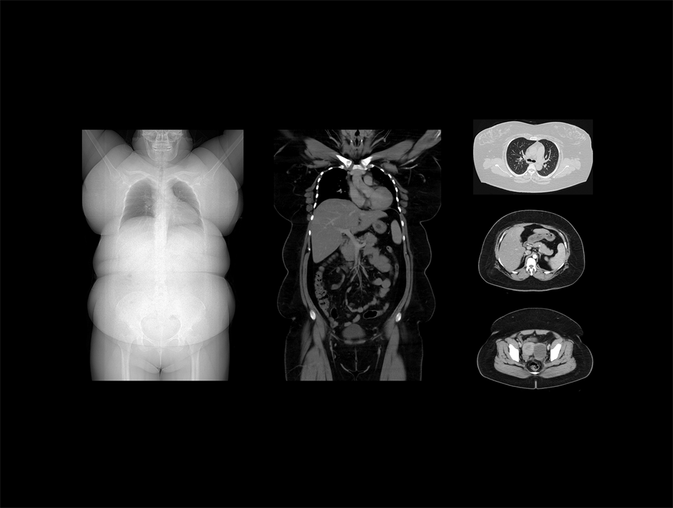 Gantry-ul ultra-larg de 82 cm permite poziționarea flexibilă a pacienților bariatrici.