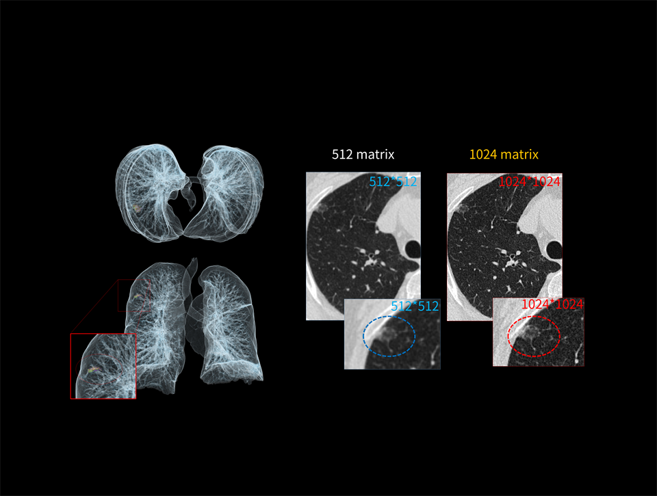 Matricea de reconstrucție de înaltă definiție evidențiază nodulii de dimensiuni reduse.