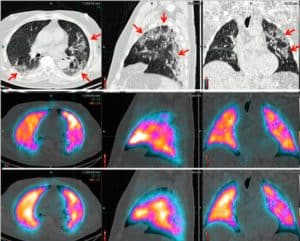 V/Q Scan cu Technegas