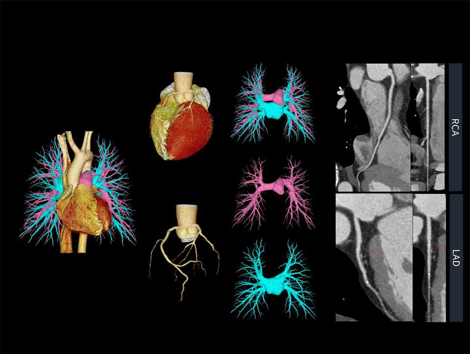 Imagistica rapidă și precisă „triple rule-out” poate fi realizată cu o viteză de rotație de 0,25 secunde.