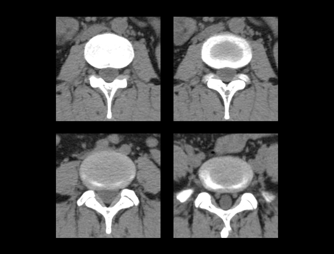 Scanare coloană lombară (L-spine)