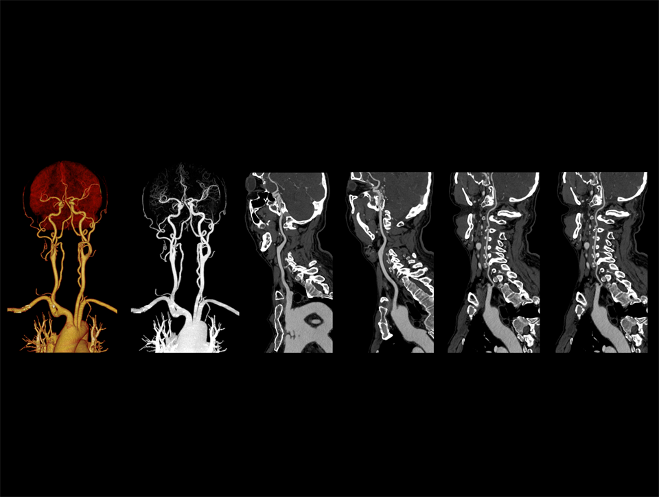 Extracția automată și precisă a vaselor sanguine în CTA carotidian, cu afișarea clară a detaliilor vasculare.