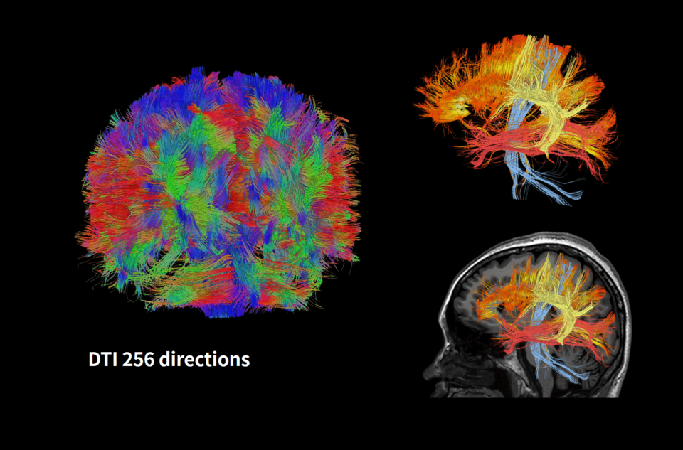 DTI cu 256 direcții pentru cap