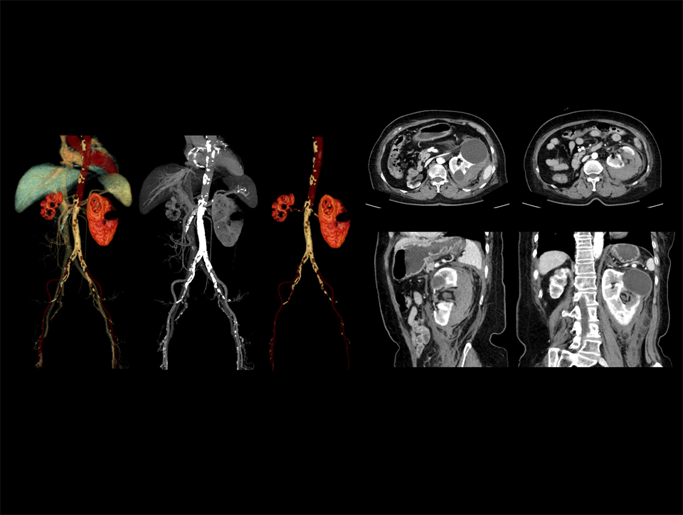 Prin combinarea fluxului de lucru AI cu un tub performant, se îmbunătățește imagistica de urgență în cazurile de traumatisme severe, precum ruptura de rinichi.