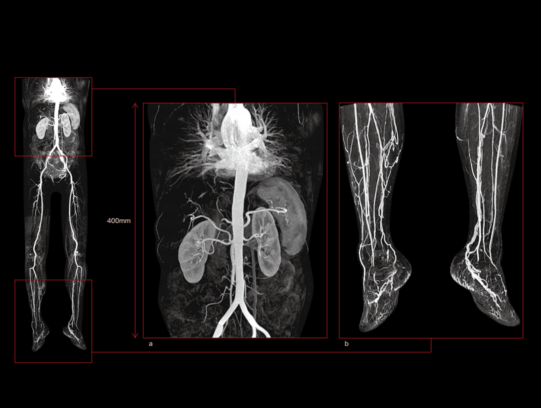 Arterele corpului și ale membrelor inferioare CE-MRA