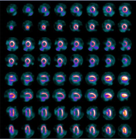 Imagistica perfuziei miocardice 4 min stres / 6 min repaus