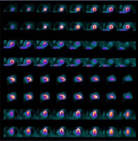 Imagistica perfuziei miocardice 4 min stres / 6 min repaus