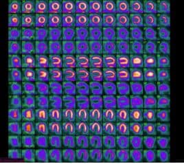 Perfuzie miocardică