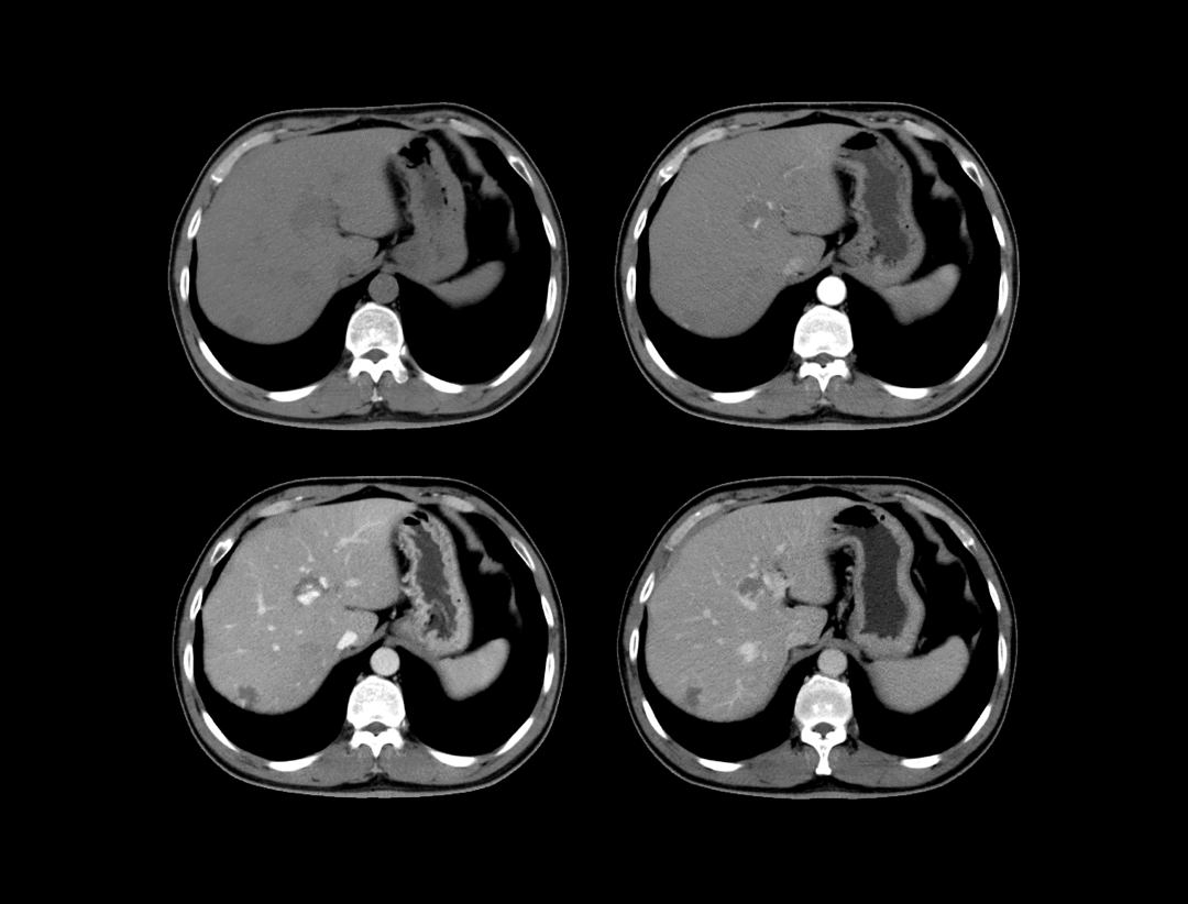 Scanare abdominală cu substanță de contrast
