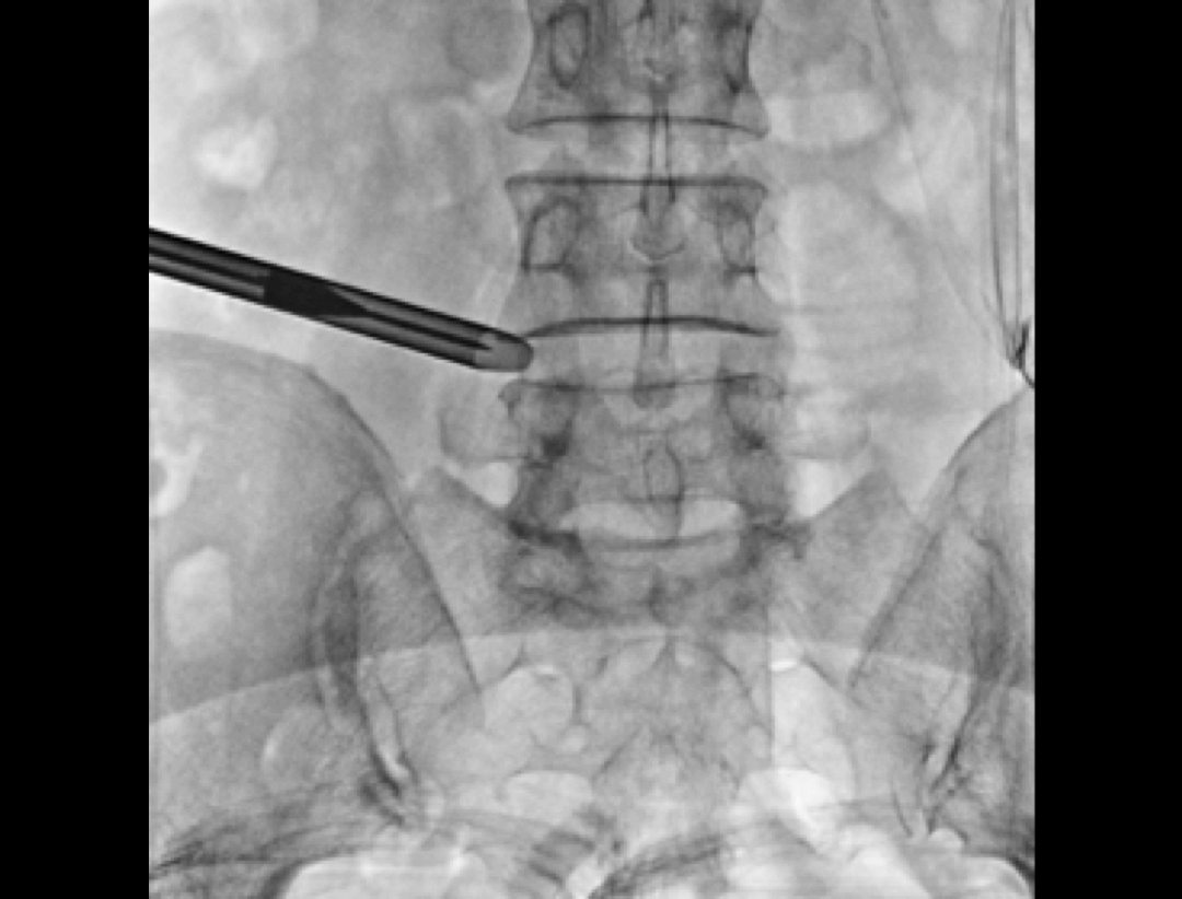 Discectomie endoscopică transforaminală percutanată