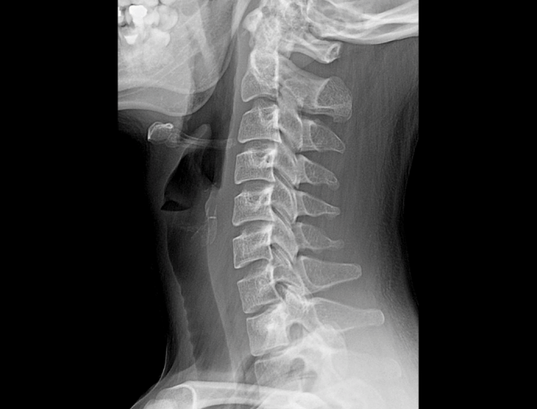 Vertebre cervicale LAT