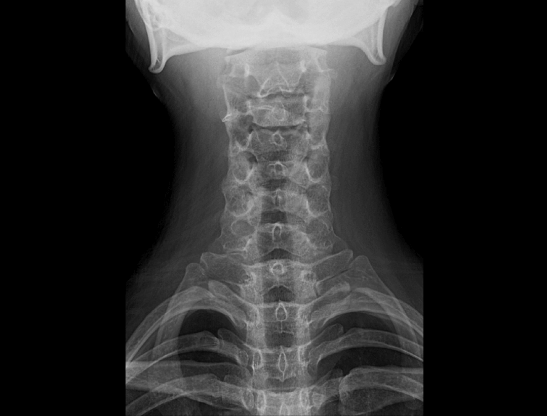 Vertebre cervicale AP 