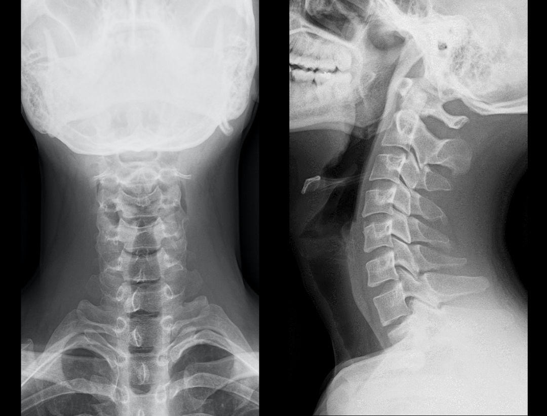Vertebre cervicale AP & LAT