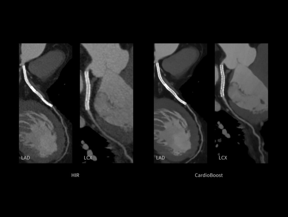 Reducerea zgomotului imaginii, oferind o vizualizare mai clară a arterelor coronare și îmbunătățirea contrastului în interiorul vaselor cu stent.