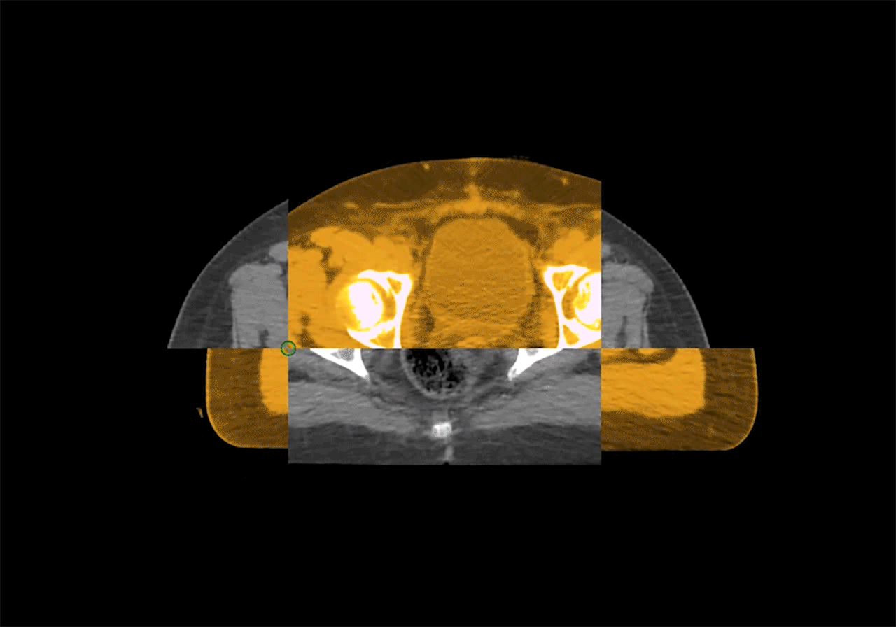 Înregistrare deformabilă automatizată