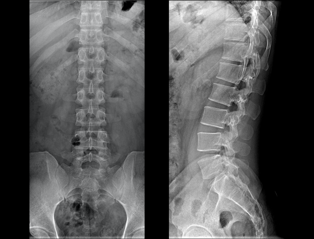 Vertebre lombare AP & LAT