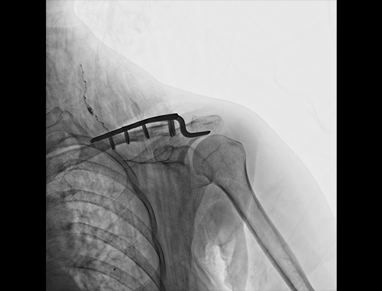 Chirurgie claviculară