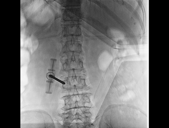 Chirurgie a coloanei lombare