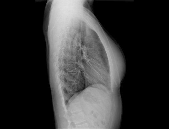 Radiografie toracică laterală
